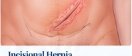Incisional Hernia