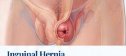 Inguinal Hernia