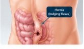 What is Hernia Diagram